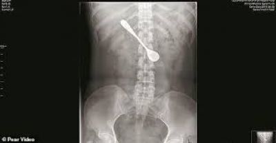 Homem descobre que tinha uma colher no intestino há cinco meses após acreditar que incidente não passou de um sonho